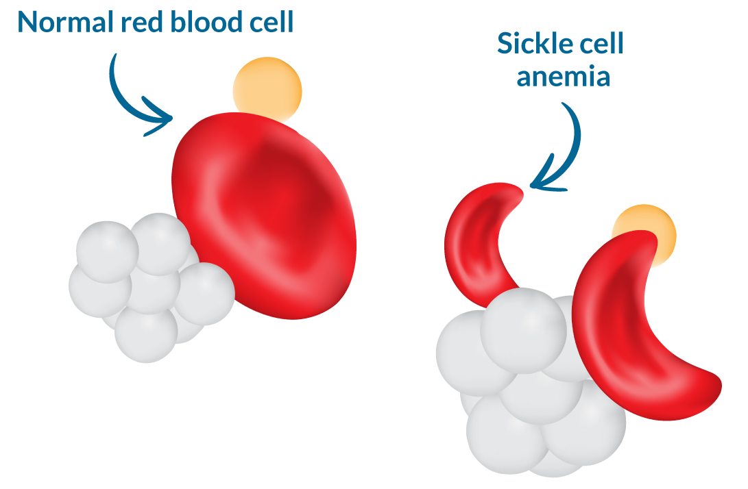 Hen imod Menneskelige race afslappet Sickle cell anemia – AAFC