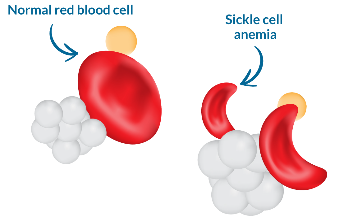 sickle cell vs normal cell